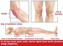 Basınç Yaraları Nelerdir? Basınç Yaraları Nelerdir?